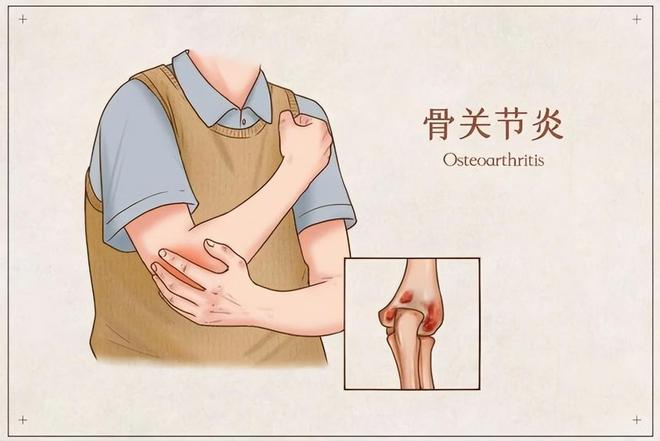 长期出现这些症状可能是关节炎在作怪！球王会体育网站且行且珍“膝”!老年人(图3)
